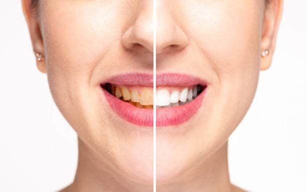 Teeth Whitening Milton Keynes Nottingham