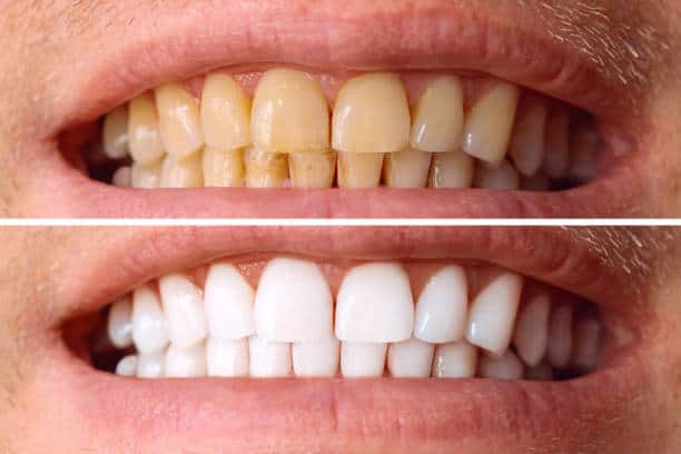 Laser White For Ever Bright – Get a Brighter, Whiter Smile with LA Teeth Whitening Nottingham