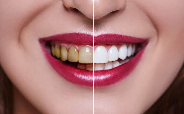 Teeth Whitening Ascot Windsor Nottingham