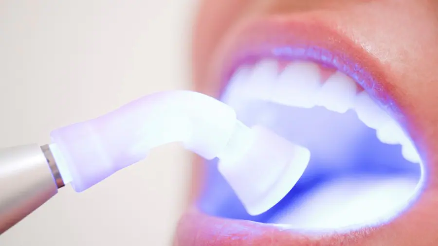 Teeth Whitening Aylesbury Nottingham